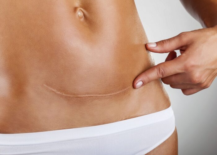 cesarea Scar of caesarean section