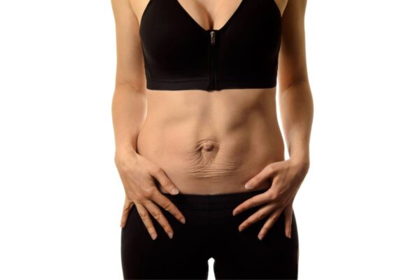 DIASTASIS_DE_RECTOS DIASTASIS_DE_RECTOS
